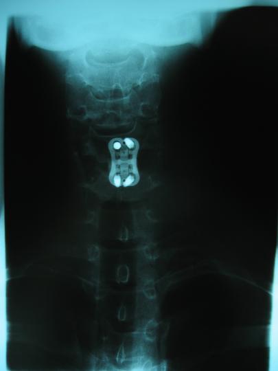 Cervical Fusion, C5/C6; front view